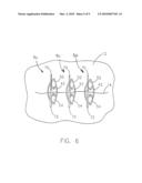 STAPLING DEVICE FOR CLOSING PERFORATIONS diagram and image