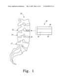 PEEK Spinal Mesh and PEEK Spinal Mesh Applicator diagram and image