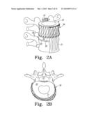 PEEK Spinal Mesh and PEEK Spinal Mesh Applicator diagram and image