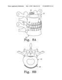 PEEK Spinal Mesh and PEEK Spinal Mesh Applicator diagram and image