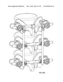 BONE ANCHOR FOR RECEIVING A ROD FOR STABILIZATION AND MOTION PRESERVATION SPINAL IMPLANTATION SYSTEM AND METHOD diagram and image