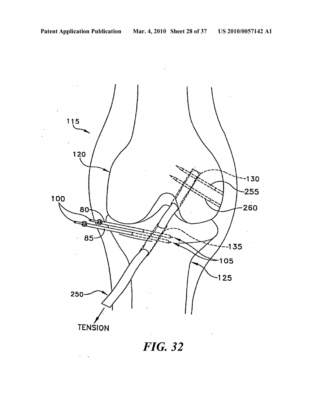 METHOD AND APPARATUS FOR FIXING A GRAFT IN A BONE TUNNEL - diagram, schematic, and image 29