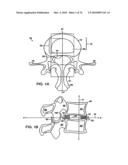 INTERIOR AND EXTERIOR SUPPORT SYSTEM FOR INTERVERTEBRAL DISC REPAIR diagram and image