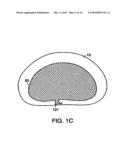 INTERIOR AND EXTERIOR SUPPORT SYSTEM FOR INTERVERTEBRAL DISC REPAIR diagram and image