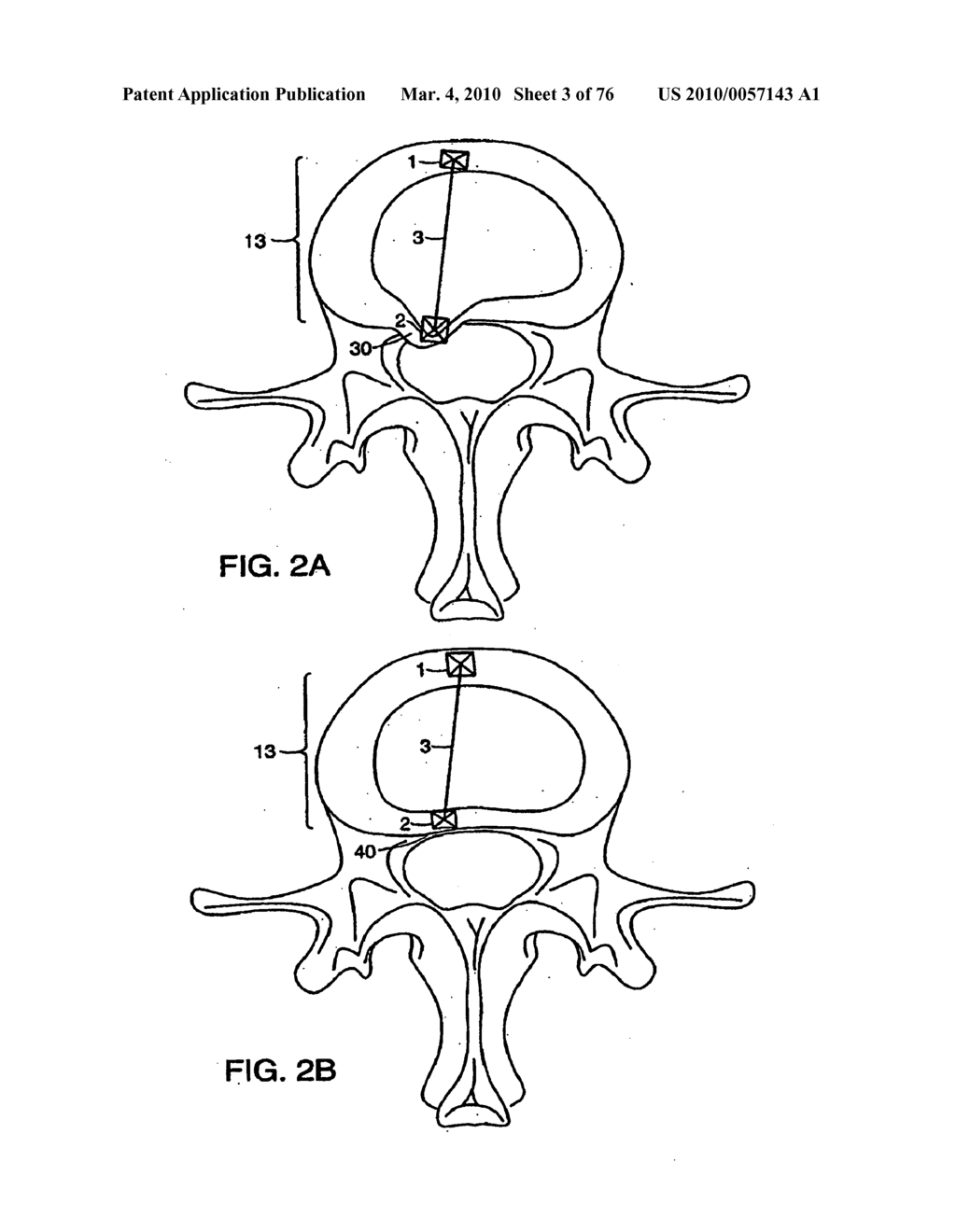 INTERIOR AND EXTERIOR SUPPORT SYSTEM FOR INTERVERTEBRAL DISC REPAIR - diagram, schematic, and image 04