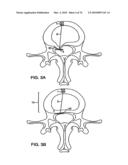 INTERIOR AND EXTERIOR SUPPORT SYSTEM FOR INTERVERTEBRAL DISC REPAIR diagram and image