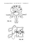 INTERIOR AND EXTERIOR SUPPORT SYSTEM FOR INTERVERTEBRAL DISC REPAIR diagram and image