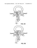 INTERIOR AND EXTERIOR SUPPORT SYSTEM FOR INTERVERTEBRAL DISC REPAIR diagram and image