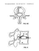 INTERIOR AND EXTERIOR SUPPORT SYSTEM FOR INTERVERTEBRAL DISC REPAIR diagram and image