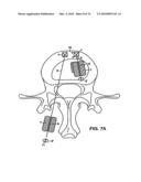 INTERIOR AND EXTERIOR SUPPORT SYSTEM FOR INTERVERTEBRAL DISC REPAIR diagram and image