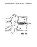 INTERIOR AND EXTERIOR SUPPORT SYSTEM FOR INTERVERTEBRAL DISC REPAIR diagram and image