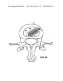 INTERIOR AND EXTERIOR SUPPORT SYSTEM FOR INTERVERTEBRAL DISC REPAIR diagram and image