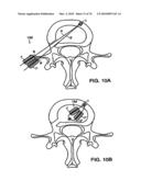 INTERIOR AND EXTERIOR SUPPORT SYSTEM FOR INTERVERTEBRAL DISC REPAIR diagram and image