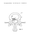 INTERIOR AND EXTERIOR SUPPORT SYSTEM FOR INTERVERTEBRAL DISC REPAIR diagram and image