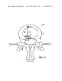 INTERIOR AND EXTERIOR SUPPORT SYSTEM FOR INTERVERTEBRAL DISC REPAIR diagram and image