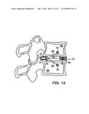 INTERIOR AND EXTERIOR SUPPORT SYSTEM FOR INTERVERTEBRAL DISC REPAIR diagram and image