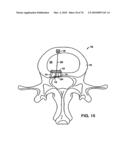 INTERIOR AND EXTERIOR SUPPORT SYSTEM FOR INTERVERTEBRAL DISC REPAIR diagram and image