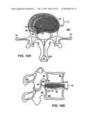 INTERIOR AND EXTERIOR SUPPORT SYSTEM FOR INTERVERTEBRAL DISC REPAIR diagram and image