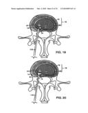 INTERIOR AND EXTERIOR SUPPORT SYSTEM FOR INTERVERTEBRAL DISC REPAIR diagram and image