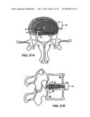 INTERIOR AND EXTERIOR SUPPORT SYSTEM FOR INTERVERTEBRAL DISC REPAIR diagram and image