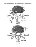 INTERIOR AND EXTERIOR SUPPORT SYSTEM FOR INTERVERTEBRAL DISC REPAIR diagram and image