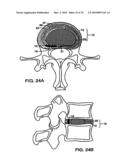 INTERIOR AND EXTERIOR SUPPORT SYSTEM FOR INTERVERTEBRAL DISC REPAIR diagram and image