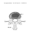 INTERIOR AND EXTERIOR SUPPORT SYSTEM FOR INTERVERTEBRAL DISC REPAIR diagram and image