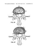 INTERIOR AND EXTERIOR SUPPORT SYSTEM FOR INTERVERTEBRAL DISC REPAIR diagram and image