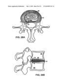 INTERIOR AND EXTERIOR SUPPORT SYSTEM FOR INTERVERTEBRAL DISC REPAIR diagram and image