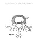 INTERIOR AND EXTERIOR SUPPORT SYSTEM FOR INTERVERTEBRAL DISC REPAIR diagram and image