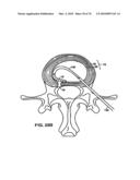 INTERIOR AND EXTERIOR SUPPORT SYSTEM FOR INTERVERTEBRAL DISC REPAIR diagram and image