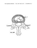 INTERIOR AND EXTERIOR SUPPORT SYSTEM FOR INTERVERTEBRAL DISC REPAIR diagram and image