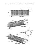 INTERIOR AND EXTERIOR SUPPORT SYSTEM FOR INTERVERTEBRAL DISC REPAIR diagram and image