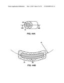 INTERIOR AND EXTERIOR SUPPORT SYSTEM FOR INTERVERTEBRAL DISC REPAIR diagram and image