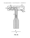 INTERIOR AND EXTERIOR SUPPORT SYSTEM FOR INTERVERTEBRAL DISC REPAIR diagram and image