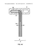 INTERIOR AND EXTERIOR SUPPORT SYSTEM FOR INTERVERTEBRAL DISC REPAIR diagram and image