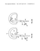 INTERIOR AND EXTERIOR SUPPORT SYSTEM FOR INTERVERTEBRAL DISC REPAIR diagram and image