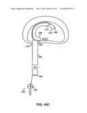 INTERIOR AND EXTERIOR SUPPORT SYSTEM FOR INTERVERTEBRAL DISC REPAIR diagram and image