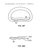 INTERIOR AND EXTERIOR SUPPORT SYSTEM FOR INTERVERTEBRAL DISC REPAIR diagram and image