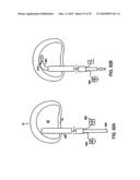 INTERIOR AND EXTERIOR SUPPORT SYSTEM FOR INTERVERTEBRAL DISC REPAIR diagram and image