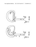 INTERIOR AND EXTERIOR SUPPORT SYSTEM FOR INTERVERTEBRAL DISC REPAIR diagram and image