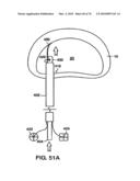 INTERIOR AND EXTERIOR SUPPORT SYSTEM FOR INTERVERTEBRAL DISC REPAIR diagram and image