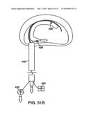 INTERIOR AND EXTERIOR SUPPORT SYSTEM FOR INTERVERTEBRAL DISC REPAIR diagram and image