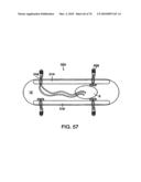 INTERIOR AND EXTERIOR SUPPORT SYSTEM FOR INTERVERTEBRAL DISC REPAIR diagram and image