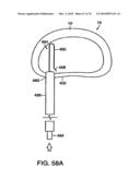 INTERIOR AND EXTERIOR SUPPORT SYSTEM FOR INTERVERTEBRAL DISC REPAIR diagram and image