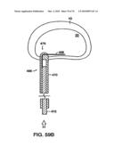 INTERIOR AND EXTERIOR SUPPORT SYSTEM FOR INTERVERTEBRAL DISC REPAIR diagram and image