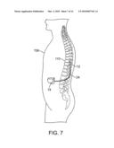 MULTIPLE TUNABLE CENTRAL CATHODES ON A PADDLE FOR INCREASED MEDIAL-LATERAL AND ROSTRAL-CAUDAL FLEXIBILITY VIA CURRENT STEERING diagram and image