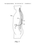 MULTIPLE TUNABLE CENTRAL CATHODES ON A PADDLE FOR INCREASED MEDIAL-LATERAL AND ROSTRAL-CAUDAL FLEXIBILITY VIA CURRENT STEERING diagram and image