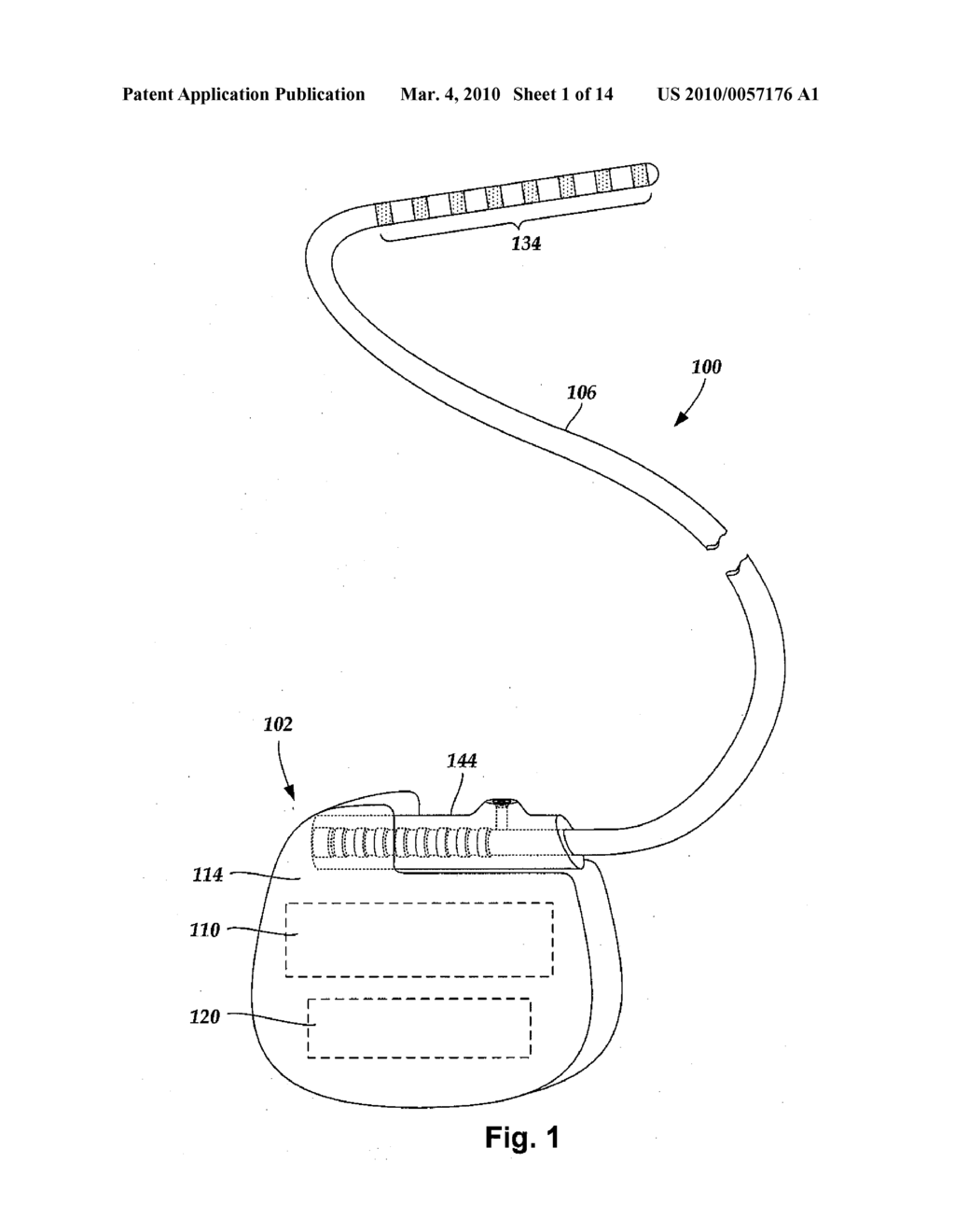 IMPLANTABLE ELECTRIC STIMULATION SYSTEM AND METHODS OF MAKING AND USING - diagram, schematic, and image 02