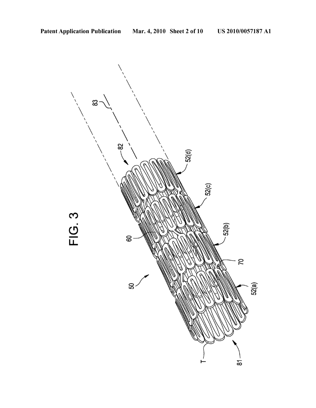 INTRAVASCULAR STENT HAVING IMRPROVED DESIGN FOR LOADING AND DEPLOYING - diagram, schematic, and image 03